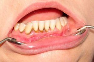 How To Remove Tartar From Teeth Home Remedy