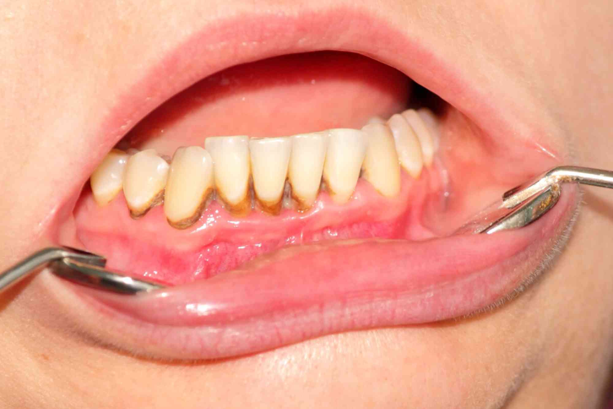 How To Remove Tartar From Teeth Home Remedy